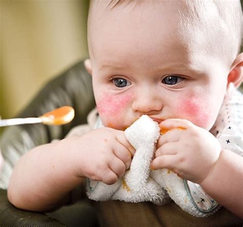 Egg Allergy Symptoms Are Easily Confused With Other Causes Learn More