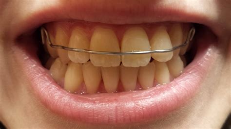 Can tight retainer damage your teeth? How Long Does It Take Teeth To Settle After Braces - Teeth ...