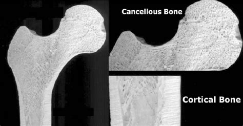 Proximal Segment Of Human Femur Expanded Segments Show Cancellous Bone