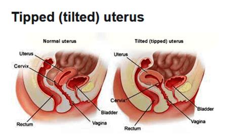 Retroverted Uterus Tilted Uterus Cause Symptoms Treatment