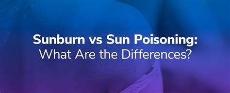 Sunburn Or Sun Poisoning Symptoms Treatments Prevention