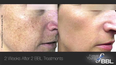 Laser Treatment Of Brown Spots Dermatology Care Of Charlotte