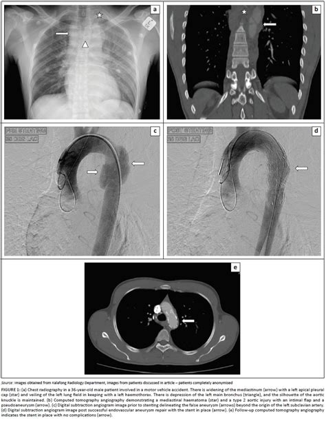 Traumatic Aortic Injury Computed Tomography Angiography Imaging And