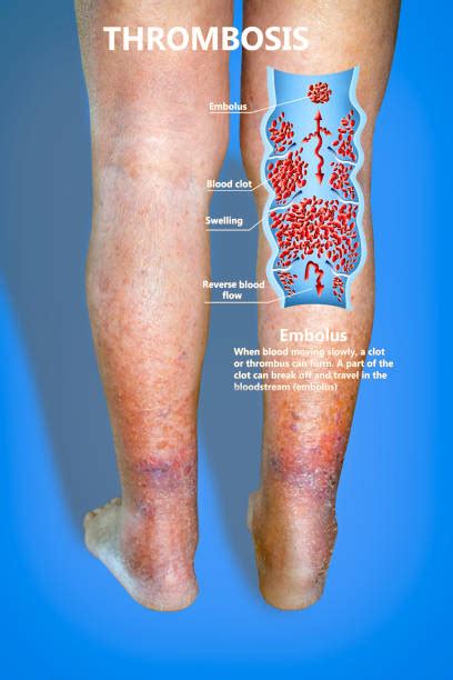 Case Superficial Phlebitis Varicose Veins Phlebitis H