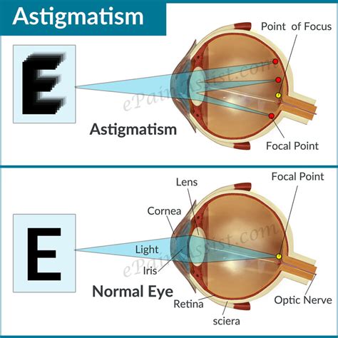 Astigmatismo Se Corrige Con Lentes Astigmatism Glaucoma Swollen Eyes