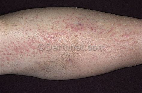 Leg Eczema Treatment Dorothee Padraig South West Skin Health Care
