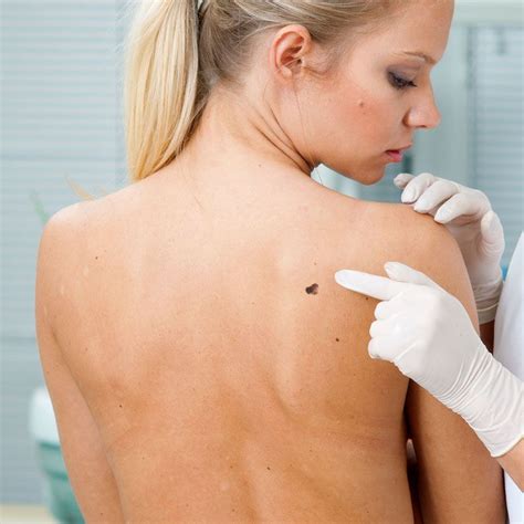 Pin On Skin Concern Sun Damage And Skin Cancer