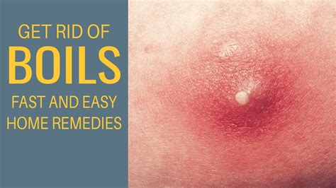 Get Rid Of Boils Fast At Home Remedies For Boils Youtube