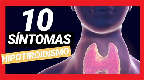 10 Signos Y SÍntomas De Hipotiroidismo GlÁndula Tiroides Youtube