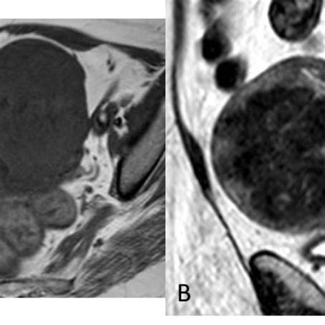 leiomyoma on mri pelvic mri axial t1 a and sagittal t2 b weighted download scientific