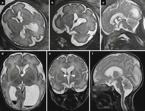 Ventriculomegaly Radiology Key