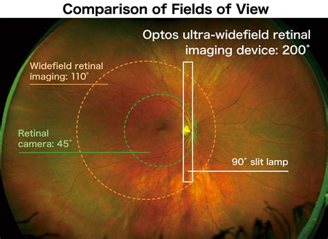 Ultra Wide Field Retinal Imaging Device Product Technology Nikon