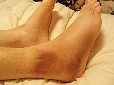 Broken Ankle Symptoms Recovery Time Pictures Surgery Treatment