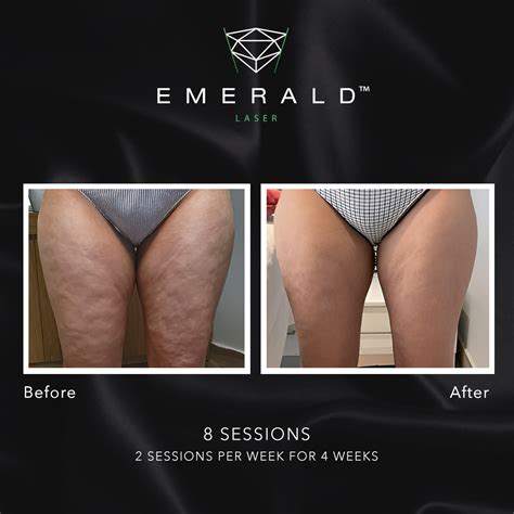 Emerald The Award Winning Fat Loss Laser Works Up To Bmi