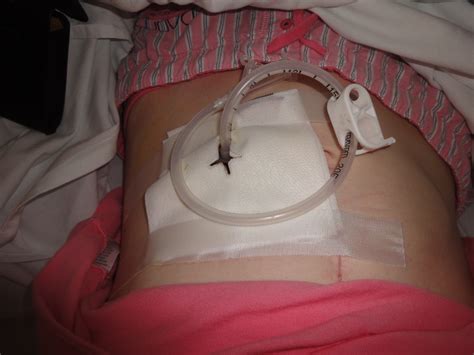 Living With Gastroparesis Tubes