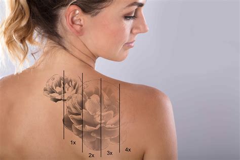 Laser Tattoo Removal Schweiger Dermatology Group