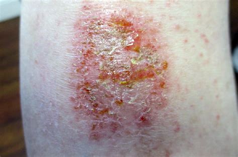 Eczema Numular Causas Sintomas E Tratamento Mdsaúde