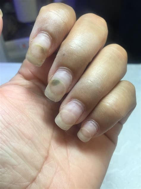 How Nail Fungus Looks Like A Comprehensive Guide Clear Nail Designs