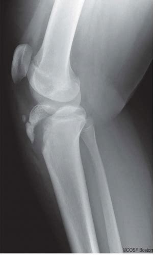 Orif Tibial Tubercle Fracture Musculoskeletal Key
