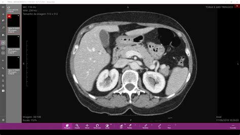 Anatomia Seccional Do Pâncreas Pela Tc Youtube