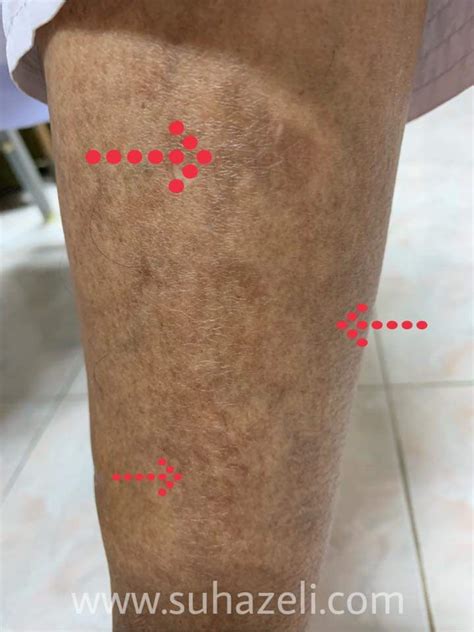 Hormon yang dihasilkan oleh plasenta mungkin akan menghalang insulin lalu menyebabkan kencing manis gestasi. Bertahun-tahun Hidap Kencing Manis, Jangan Sampai Kaki ...