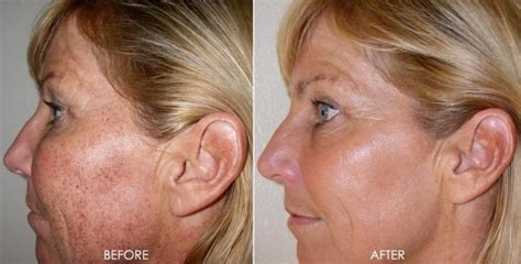Laser Treatments Dr Monica Scheel Dermatology Kailua Kona Hi
