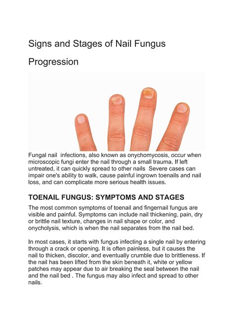 Signs And Stages Of Nail Fungus Progression By Caratin Rx Issuu