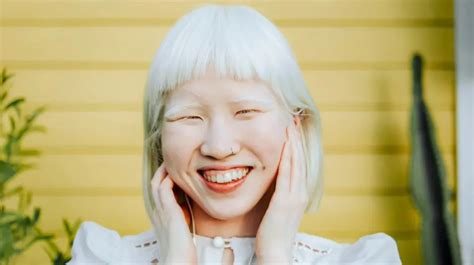 Can Albino People Dye Their Hair Everything You Need To Know After Sybil