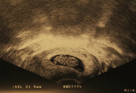 8 Weeks Pregnancy Ultrasound Scan