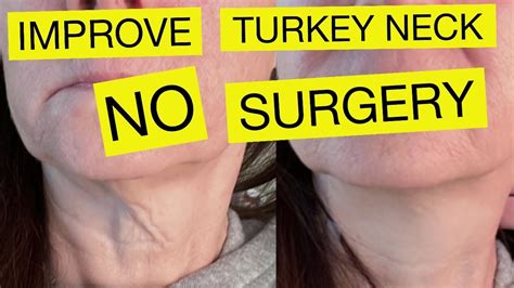 Sagging Neck Improve Saggy Neck Wrinkles Without Surgery Over 50
