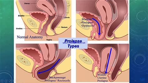 Uterine Prolapse Cystocele And Rectocele Youtube