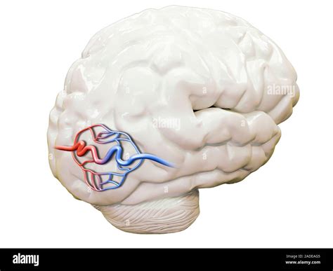 Cerebral Arteriovenous Malformation Illustration Of An Arteriovenous