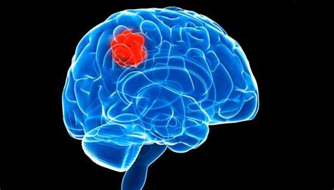 Basics Of Brain Tumors Johns Hopkins Medicine