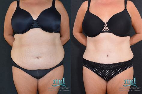 Tummy Tuck Cost In Kenya Cosmetic Surgery Tips