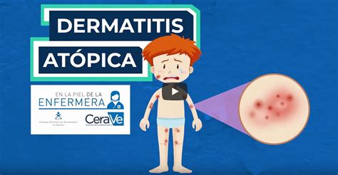 Claves Del Cuidado De La Dermatitis Atópica Una Enfermedad Que Afecta