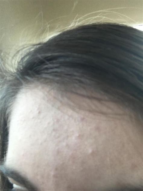 Bumps And Acne Only On The Forehead General Acne Discussion