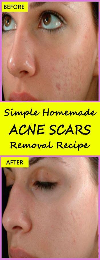 Acne Scars On Face