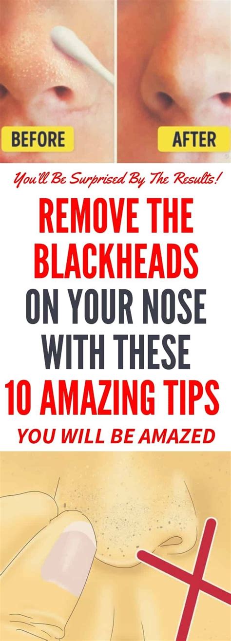 Remove The Blackheads On Your Nose With These 10 Amazing Tips Grace