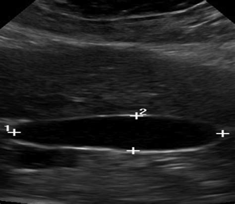 Ultrasound Evaluation Of Gallbladder Dyskinesia Comparison Of