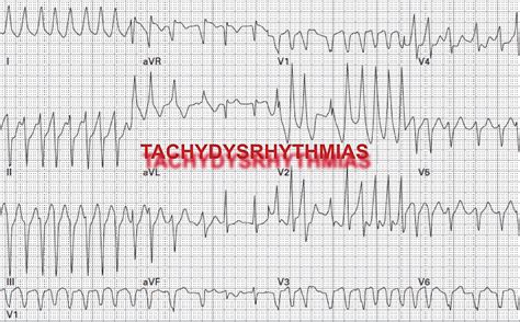 Pulseless Ventricular Tachycardia Ecg