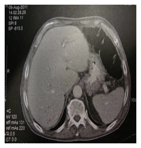 Abdominal Ct Showing Hypodense Lesions Located In The Liver And Spleen