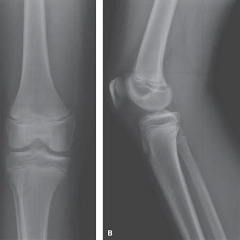 A Anteroposterior Radiograph Subtle Widening Of The Distal Femoral