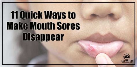 How To Relieve Mouth Sores Treatmentstop21
