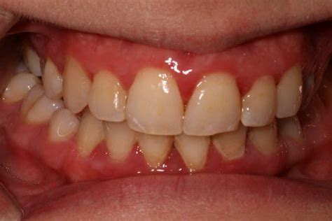 Gum Disease Pictures What Do Healthy Gums Look Like Crest