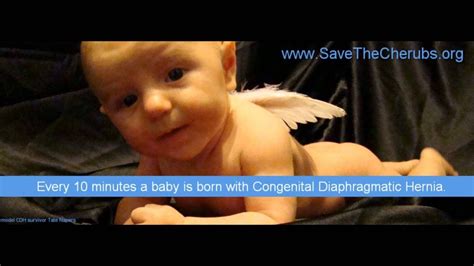 Cdh Awareness Congenital Diaphragmatic Hernia Youtube