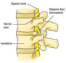 (pathology) (intr) (of an intervertebral disc) to become displaced from the normal position. ~ Umm Farhah ~: Ujian belum berakhir