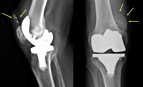 Management Of Patella In Revision Total Knee Arthroplasty A Practical Guide European Society