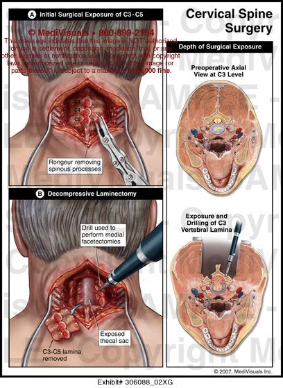 Cervical Spine Surgery Medical Illustration Medivisuals