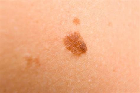 How To Get Rid Of Moles With Vinegar Hunker Howtogetridofagespots