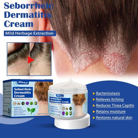 Seborrheic Dermatitis Cream Psoriasis Cream Scalp Treatment For Psoriasis Anti Itch Cream